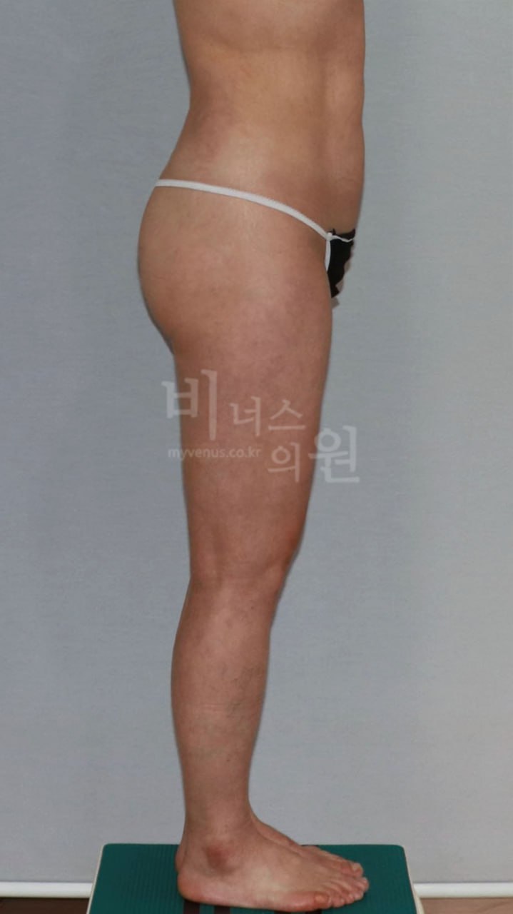 엉덩이 볼륨업 지방흡입 수술 후 후좌사면 비너스의원