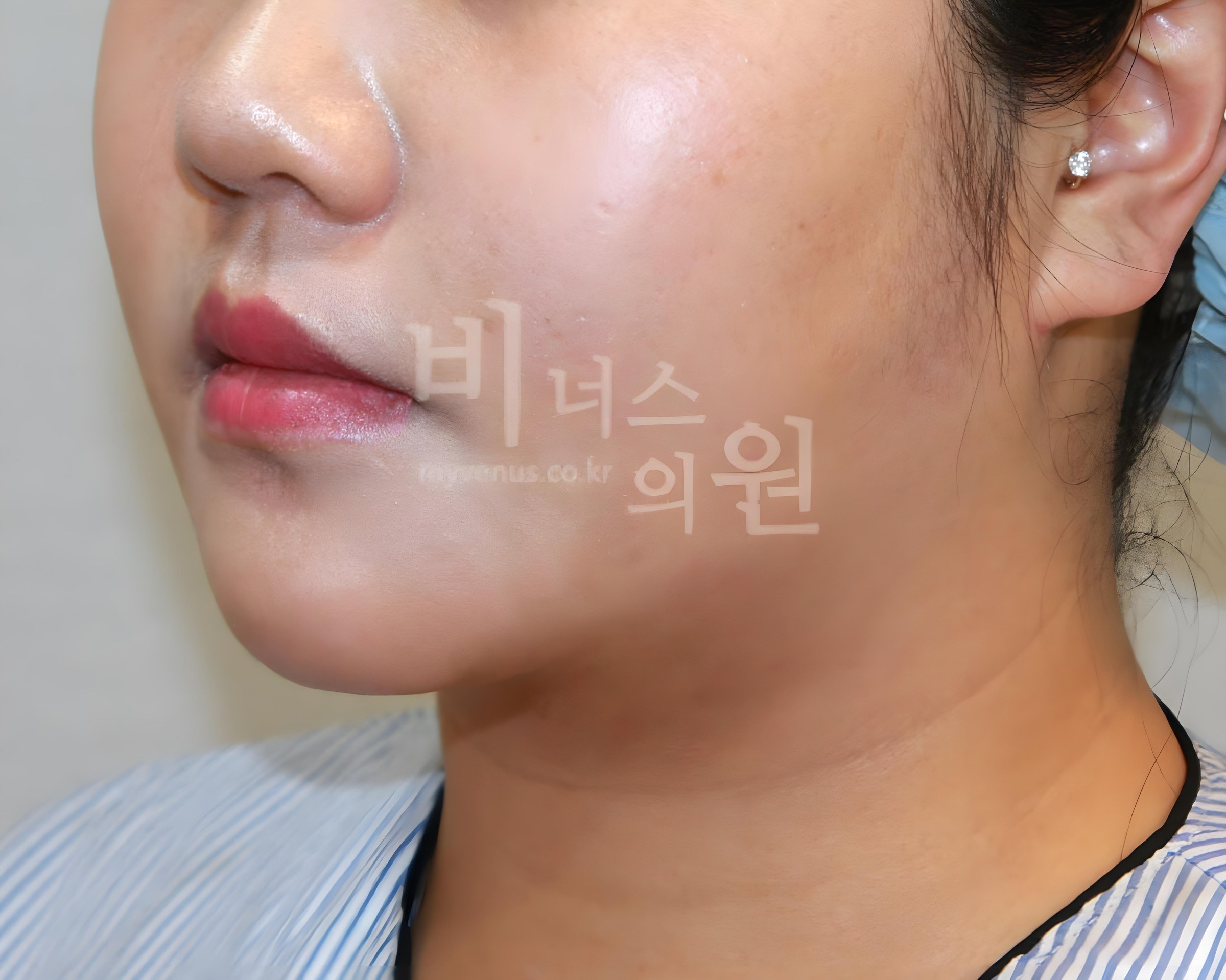턱지방흡입 후 측면 비너스의원 부천 턱선 개선