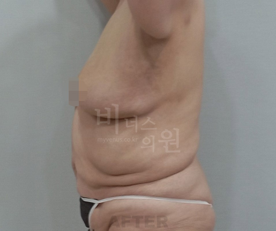 고도비만.JPG