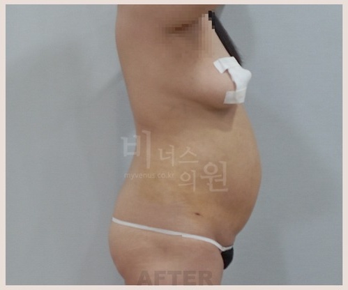 전측복부_옆구리_3_after.jpg