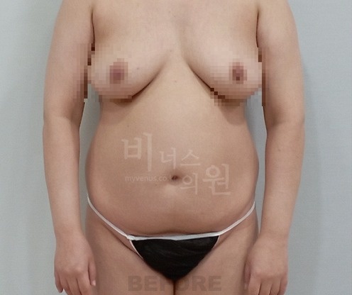 전측복부_옆구리_before.jpg