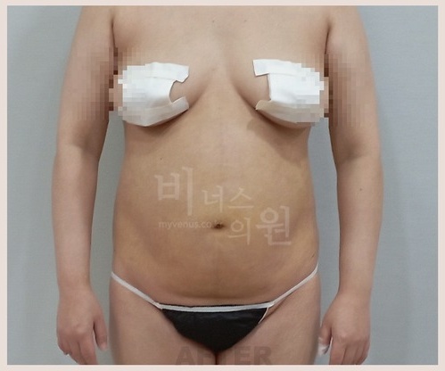 전측복부_옆구리_after.jpg