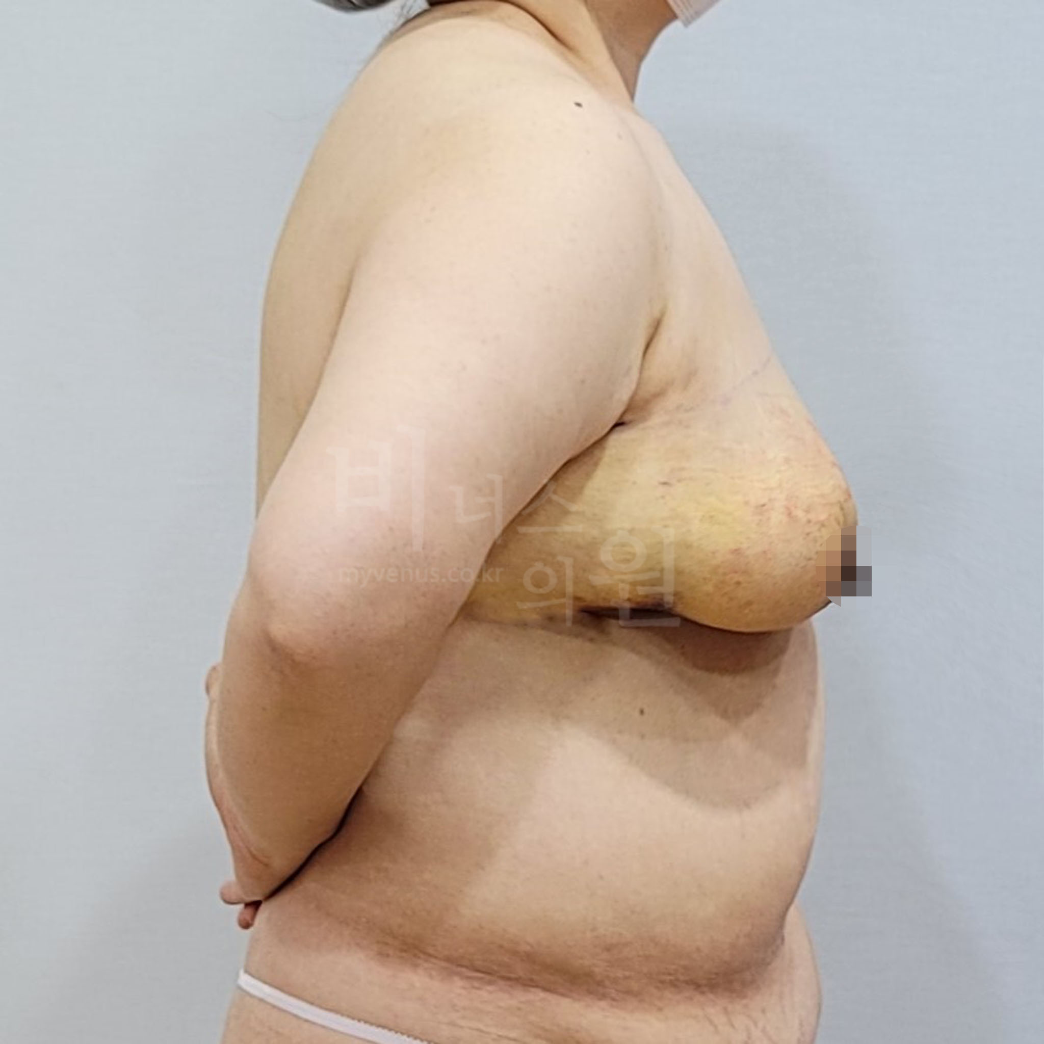 유방 지방흡입 수술 후 측면 비너스의원