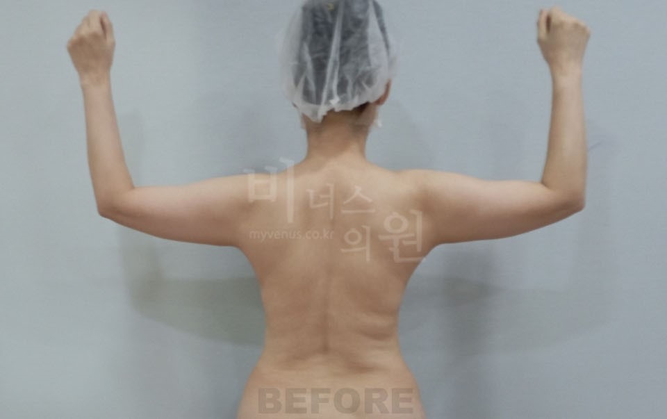 팔 지방흡입 수술 전 후면 비너스의원