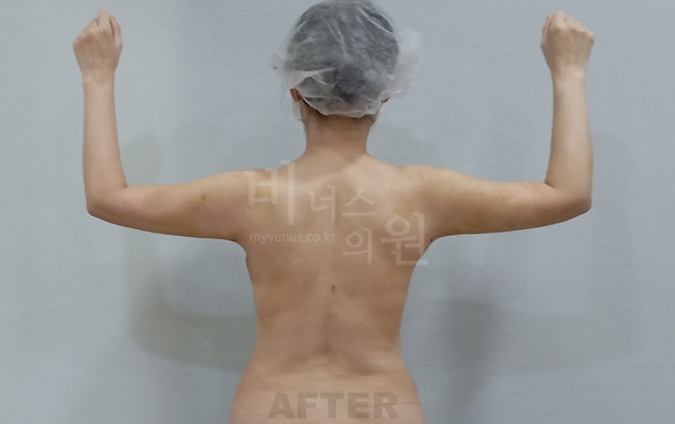 팔 지방흡입 수술 후 후면 비너스의원