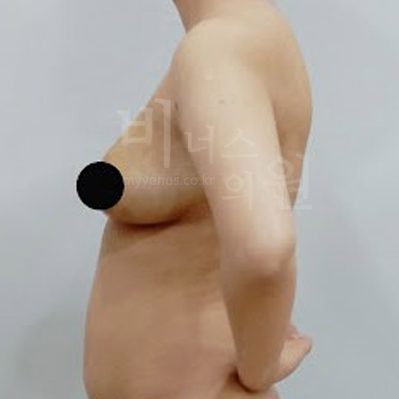 가슴축소 지방흡입 수술 전 우측 비너스의원