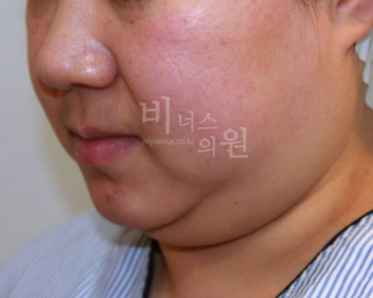 이중턱 얼굴 지방흡입 수술 전 우측 45도 비너스의원