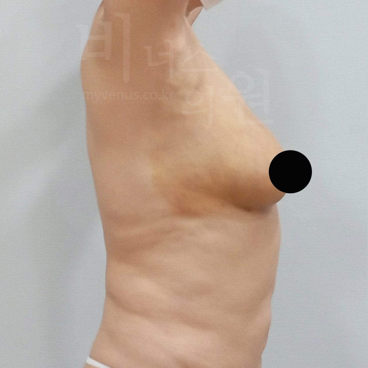 가슴축소 지방흡입 후 측면