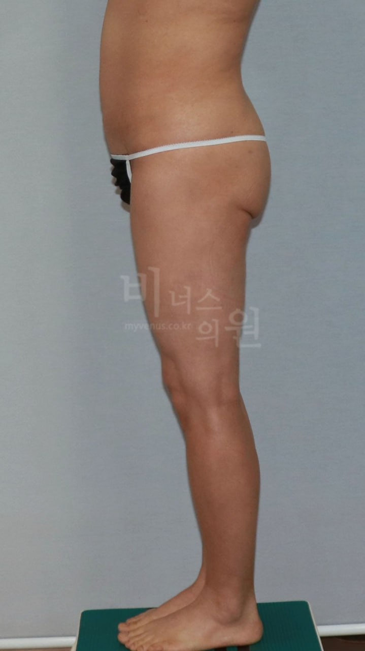 엉덩이 볼륨업 지방흡입 수술 전 측면 비너스의원