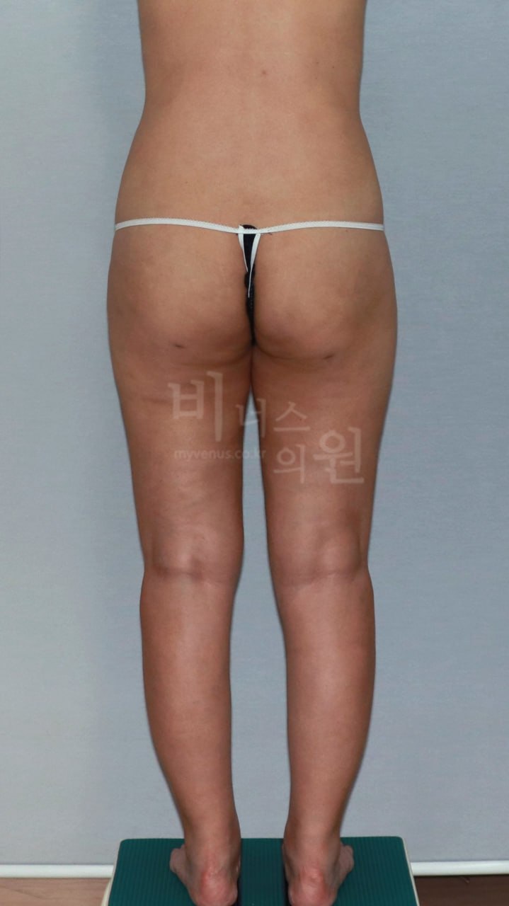 엉덩이 볼륨업 지방흡입 수술 후 후면 비너스의원