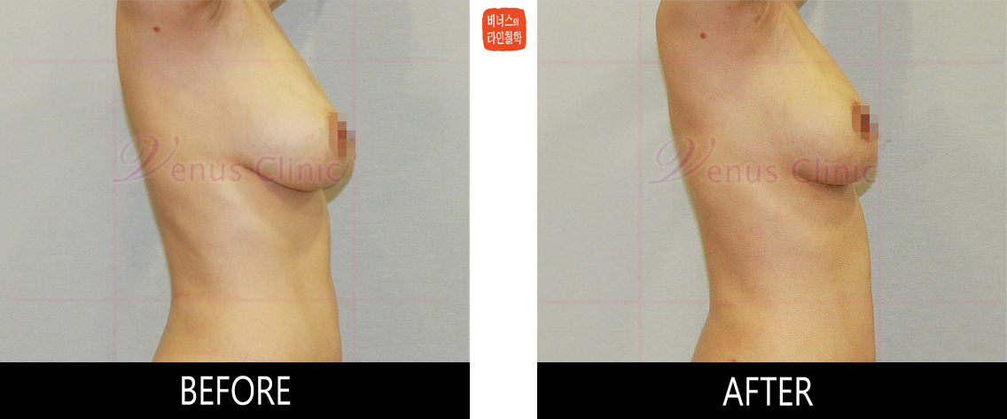 breast_liposuction-5.jpg