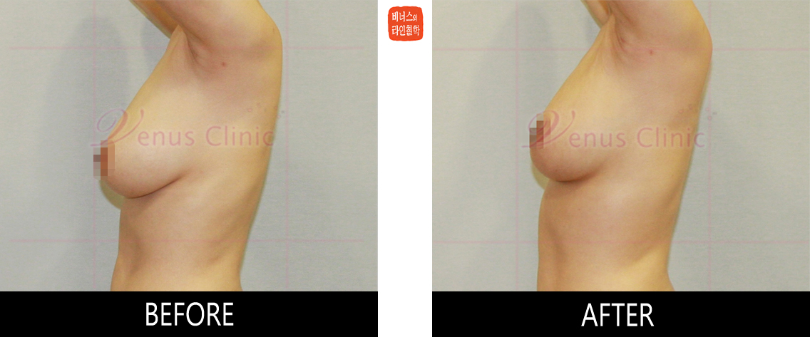 breast_liposuction-3.jpg