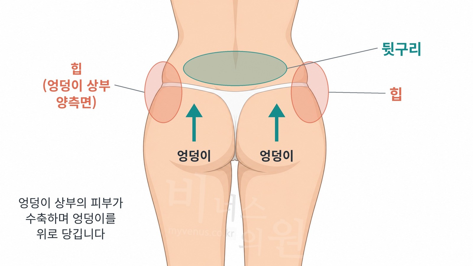 뒤에서 본 힙, 뒷구리, 엉덩이의 위치와 지방흡입 후 피부가 수축하며 엉덩이가 위로 당겨지는 방향