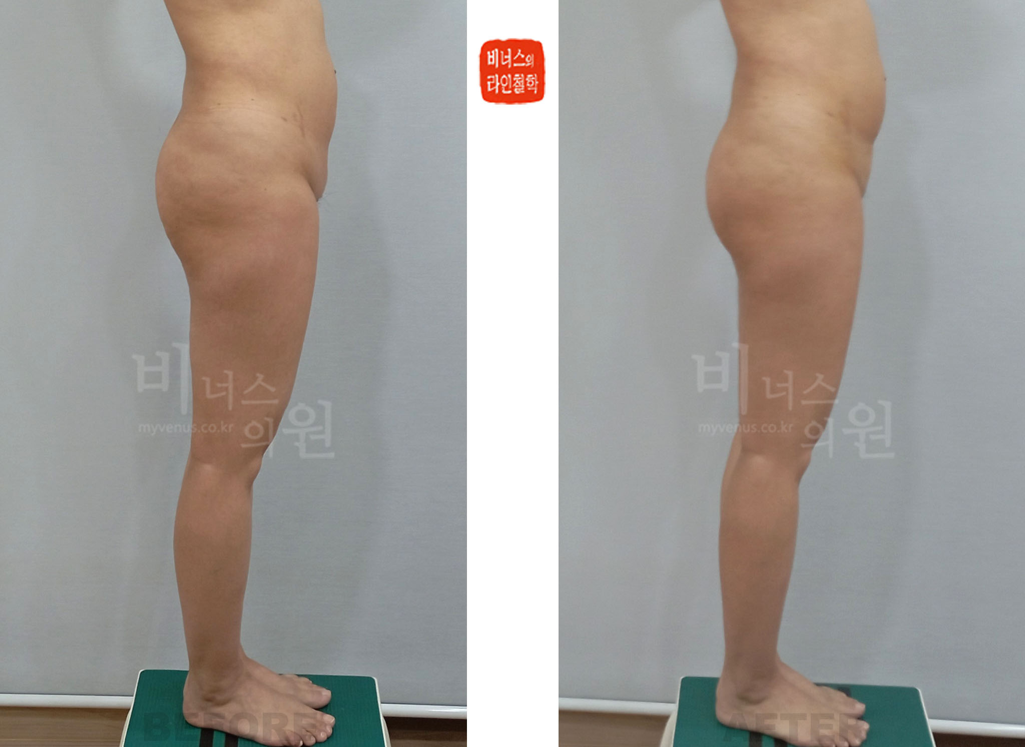2024년 치골부 골반 앞쪽 상부 허벅지 반대 측면 지방흡입 전후사진 Case 1