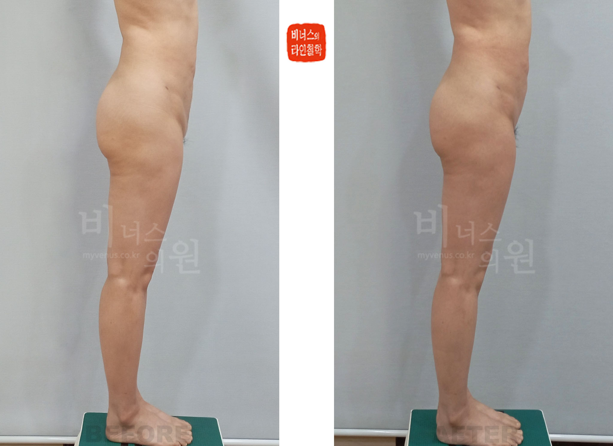 2024년 치골부 골반 앞쪽 상부 허벅지 반대 측면 지방흡입 전후사진 Case 2