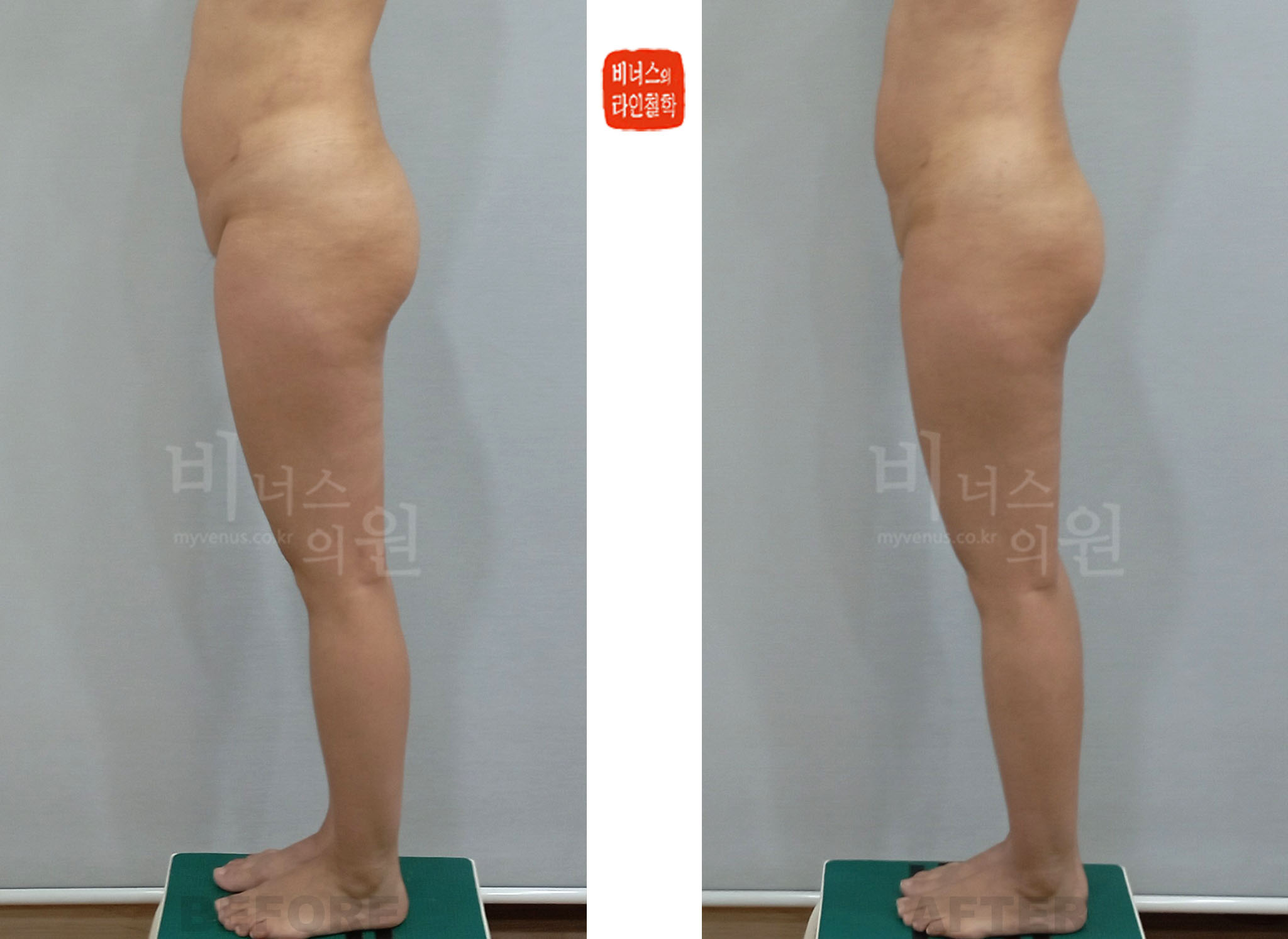 2024년 치골부 골반 앞쪽 상부 허벅지 측면 지방흡입 전후사진 Case 1