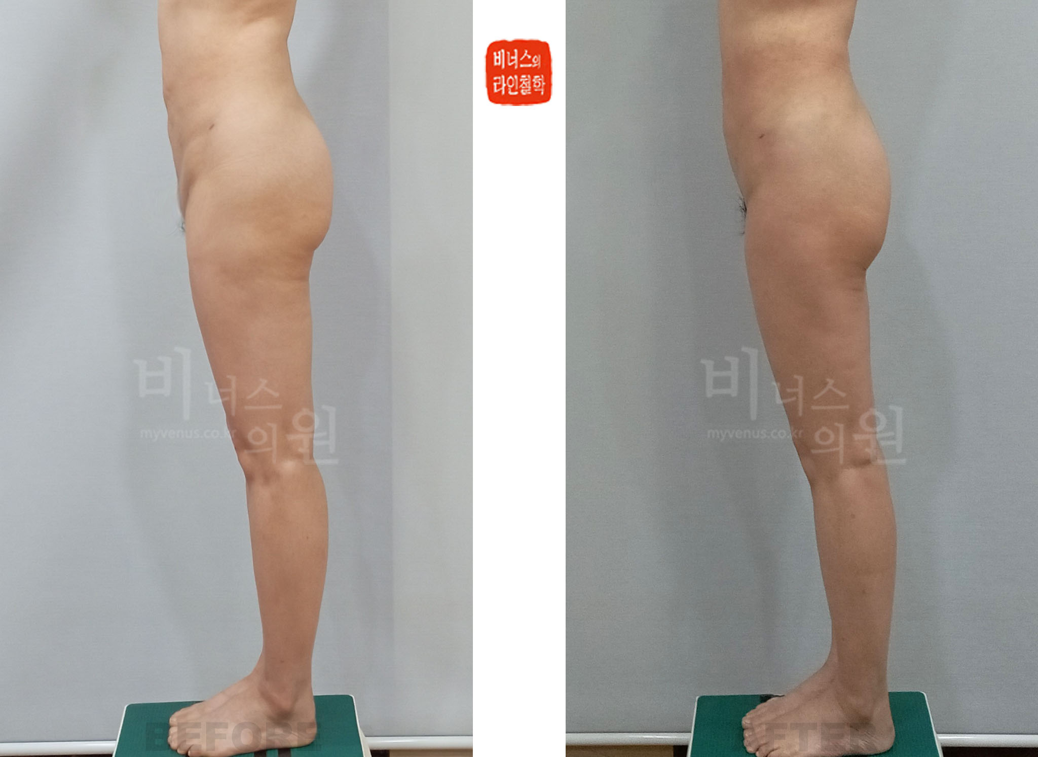 2024년 치골부 골반 앞쪽 상부 허벅지 측면 지방흡입 전후사진 Case 2