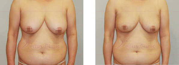 여자 유방(Female breasts) 지방흡입, 유방축소