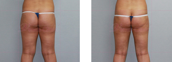 뒤쪽 허벅지의 위쪽부위(Upper posterior thigh) 지방흡입2
