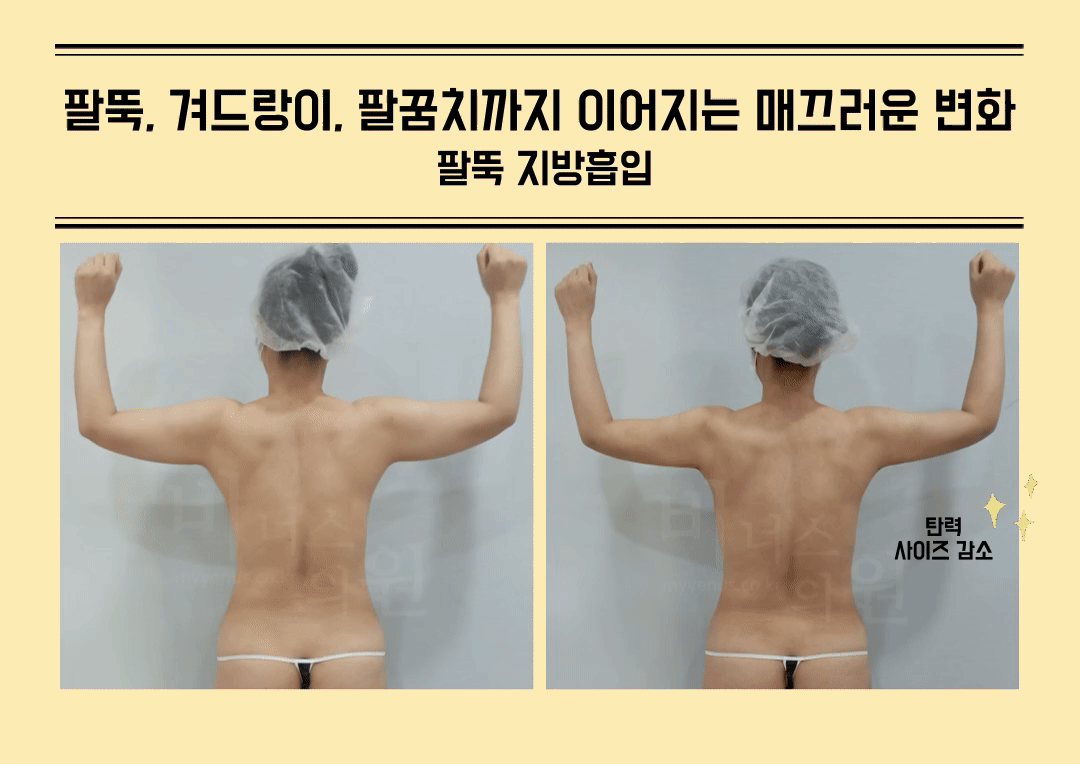 팔뚝살.gif