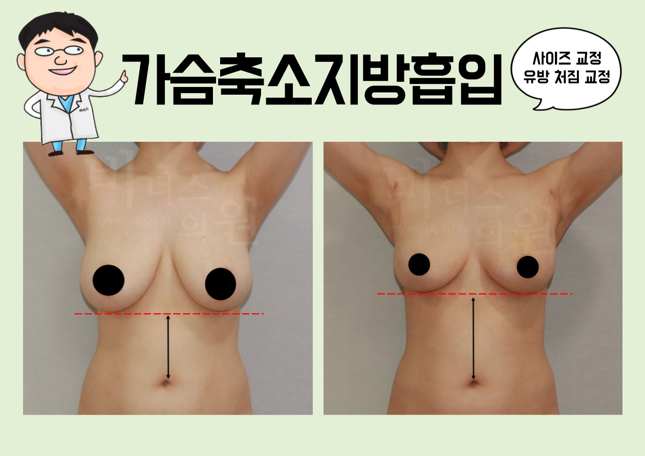 가슴축소.jpg