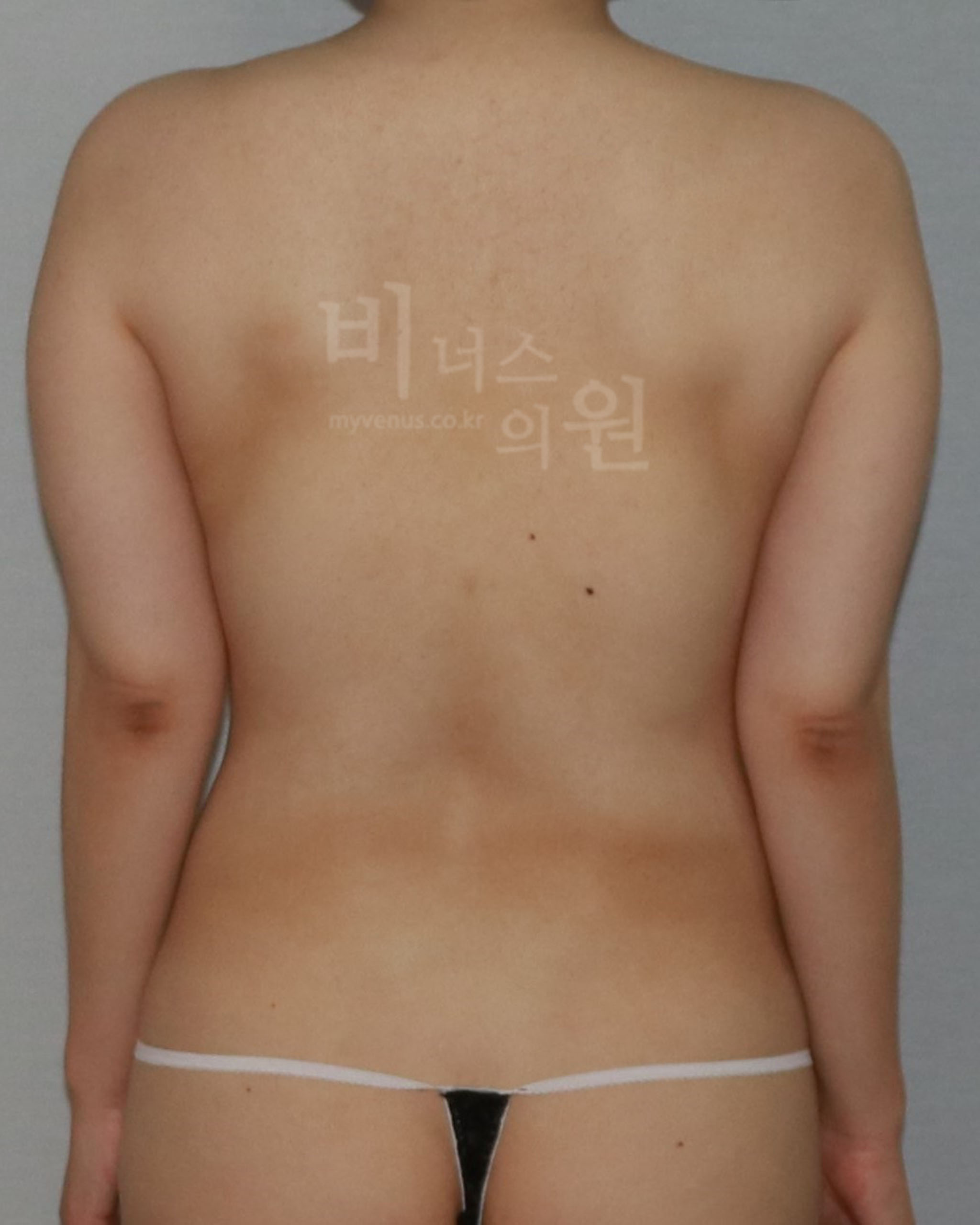 팔뚝미니지방흡입 직각 어깨 만들기.jpg