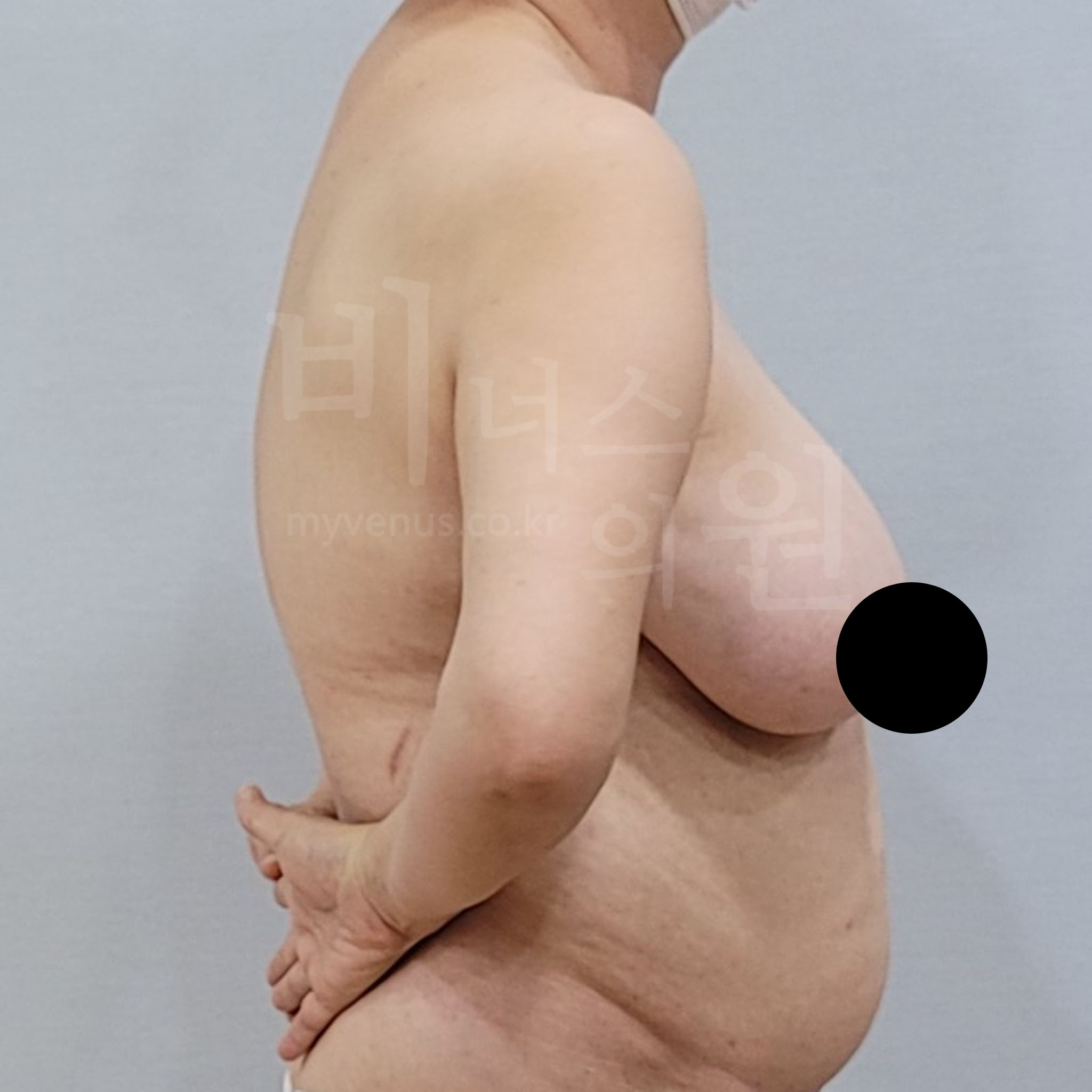 지방흡입.jpg