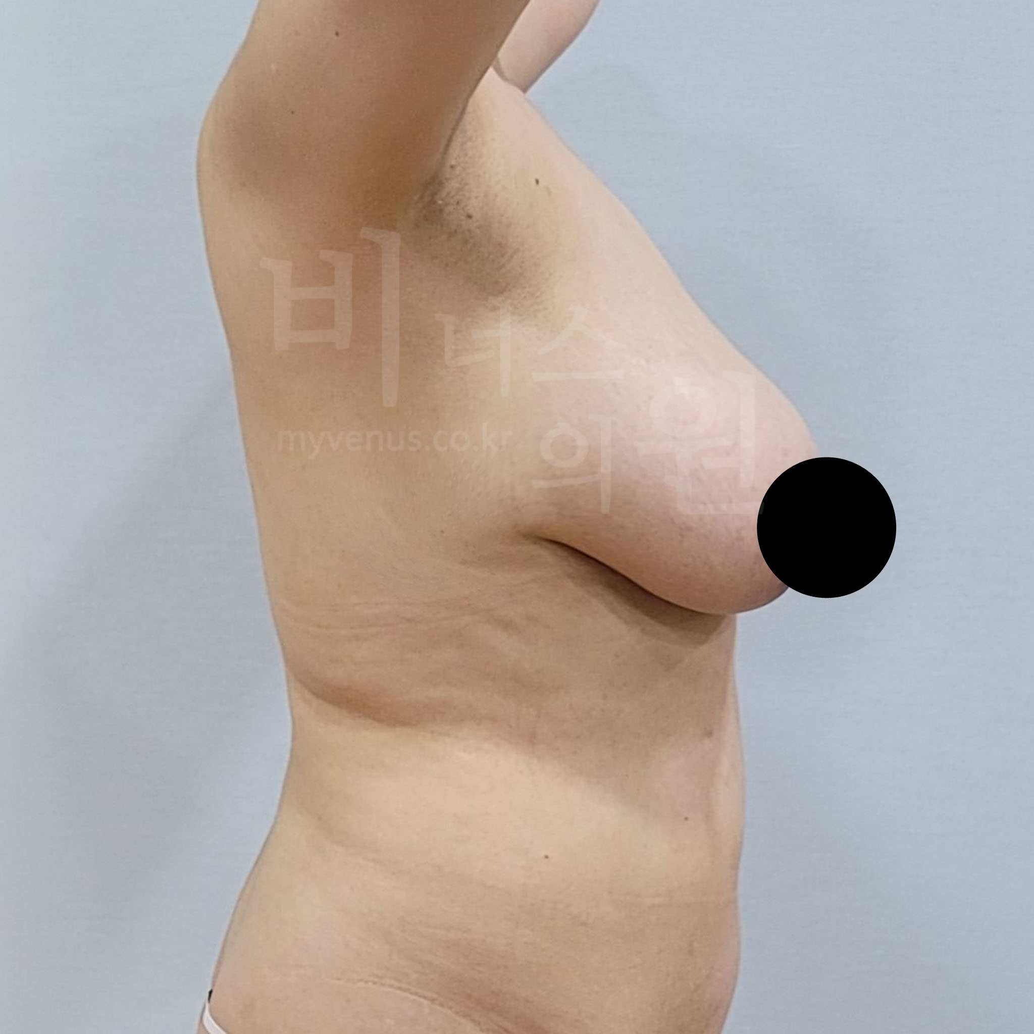 가슴 처짐 리프팅.jpg