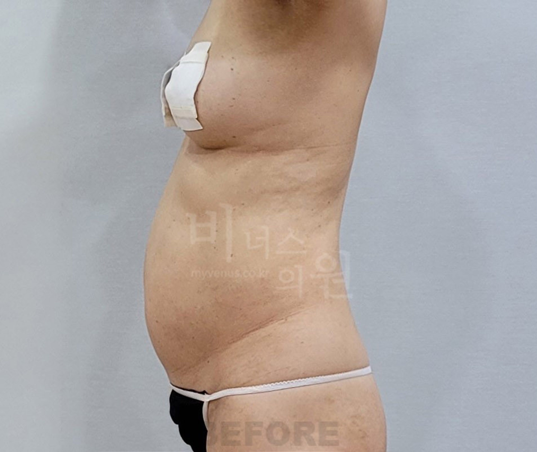 뱃살_지방흡입_5.jpg