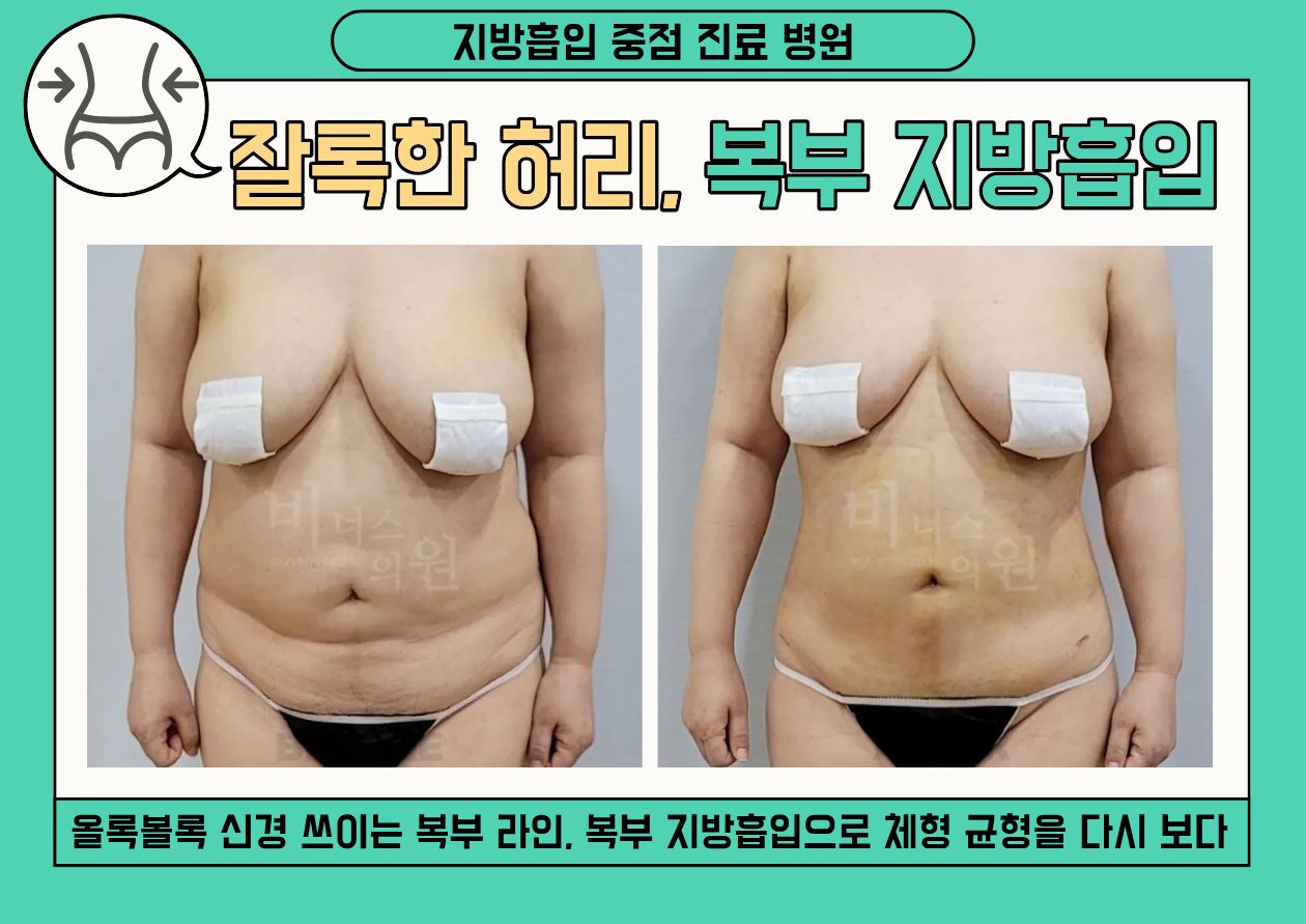 부천_뱃살지방흡입.jpg