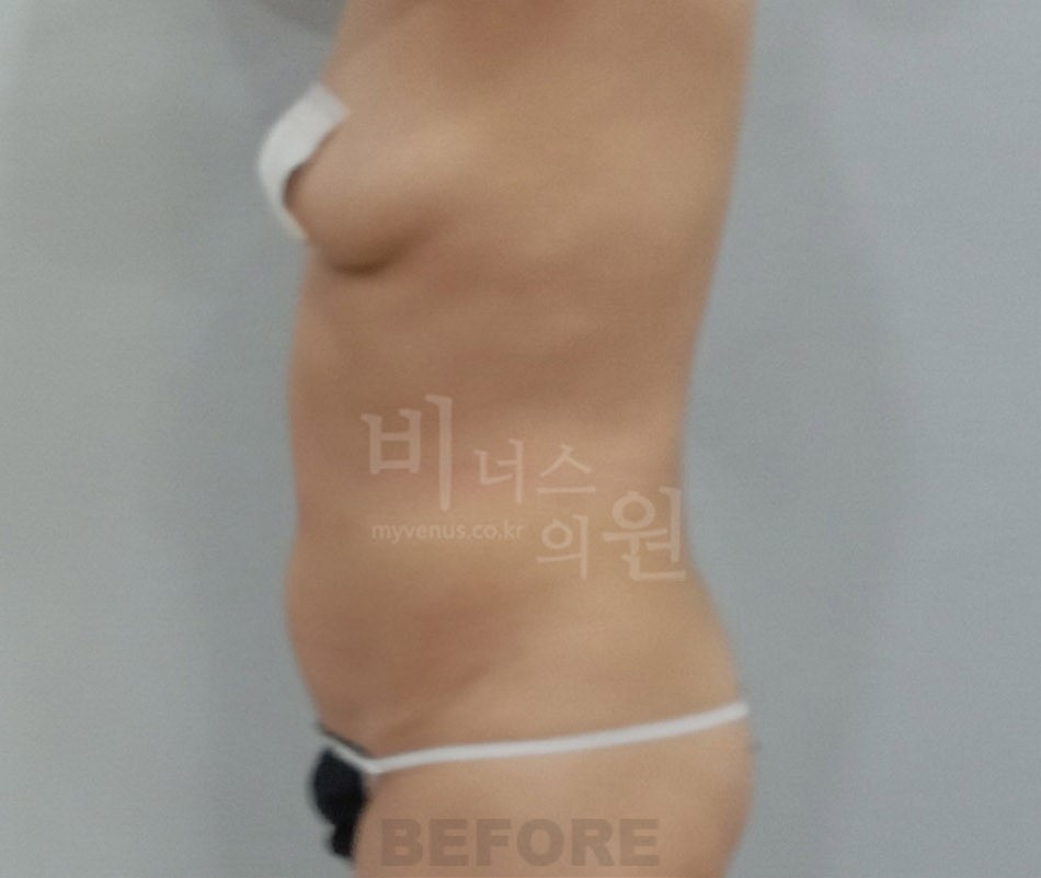 뱃살지방흡입_4.jpg