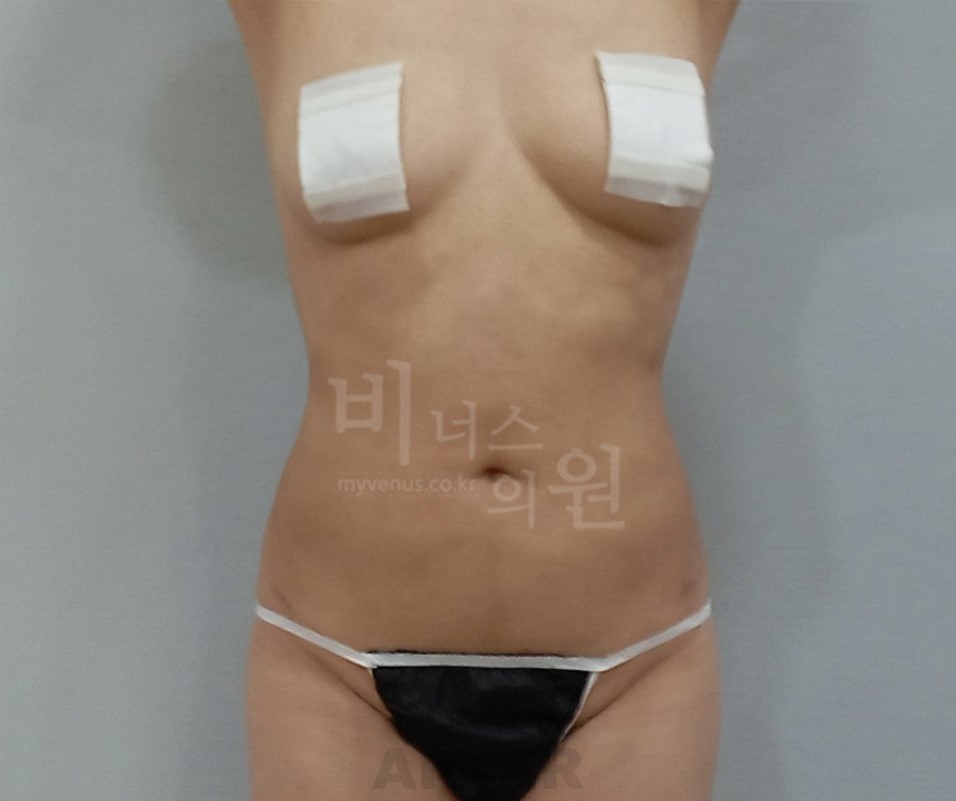 뱃살지방흡입_3.jpg