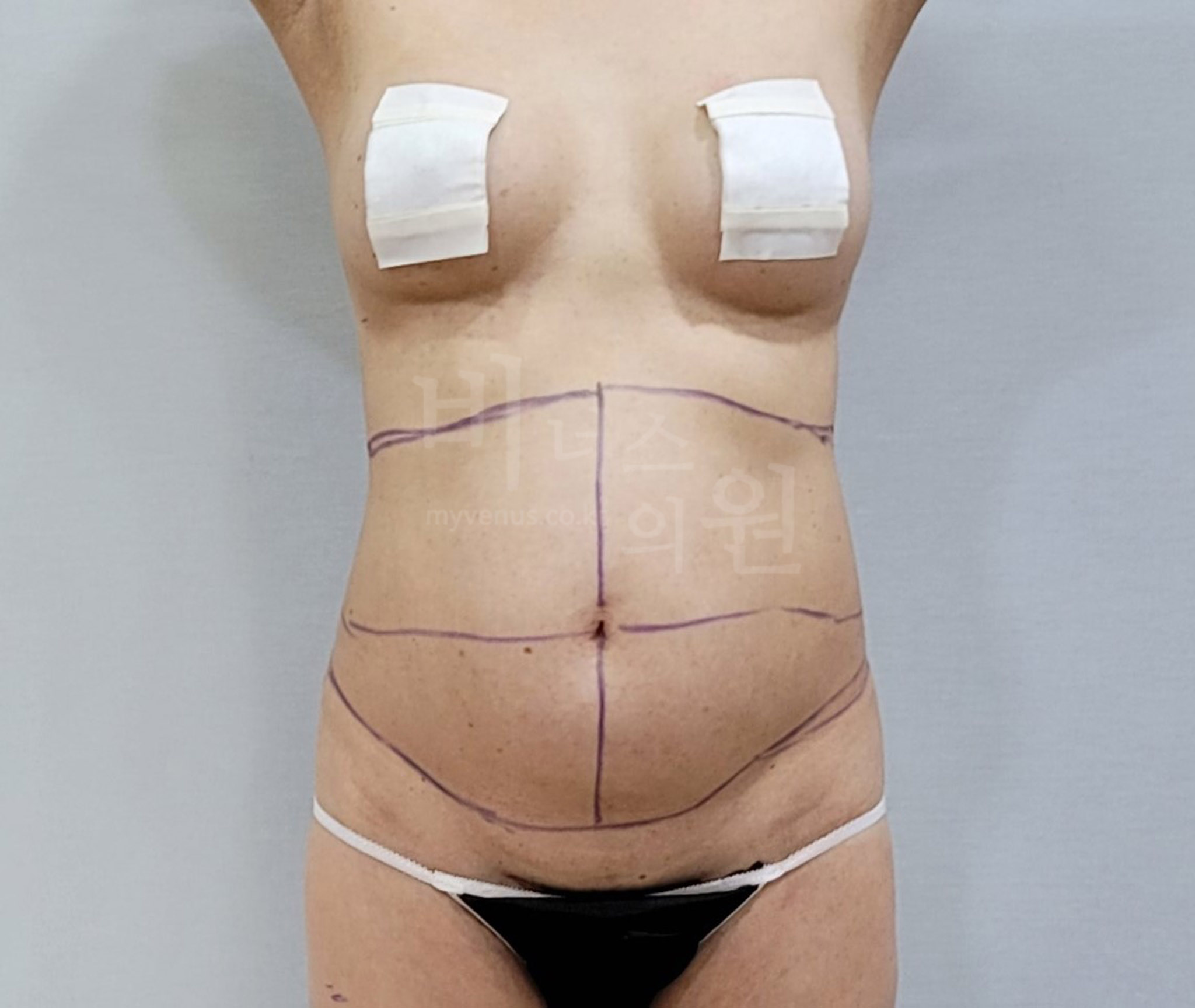뱃살_지방흡입_11.jpg