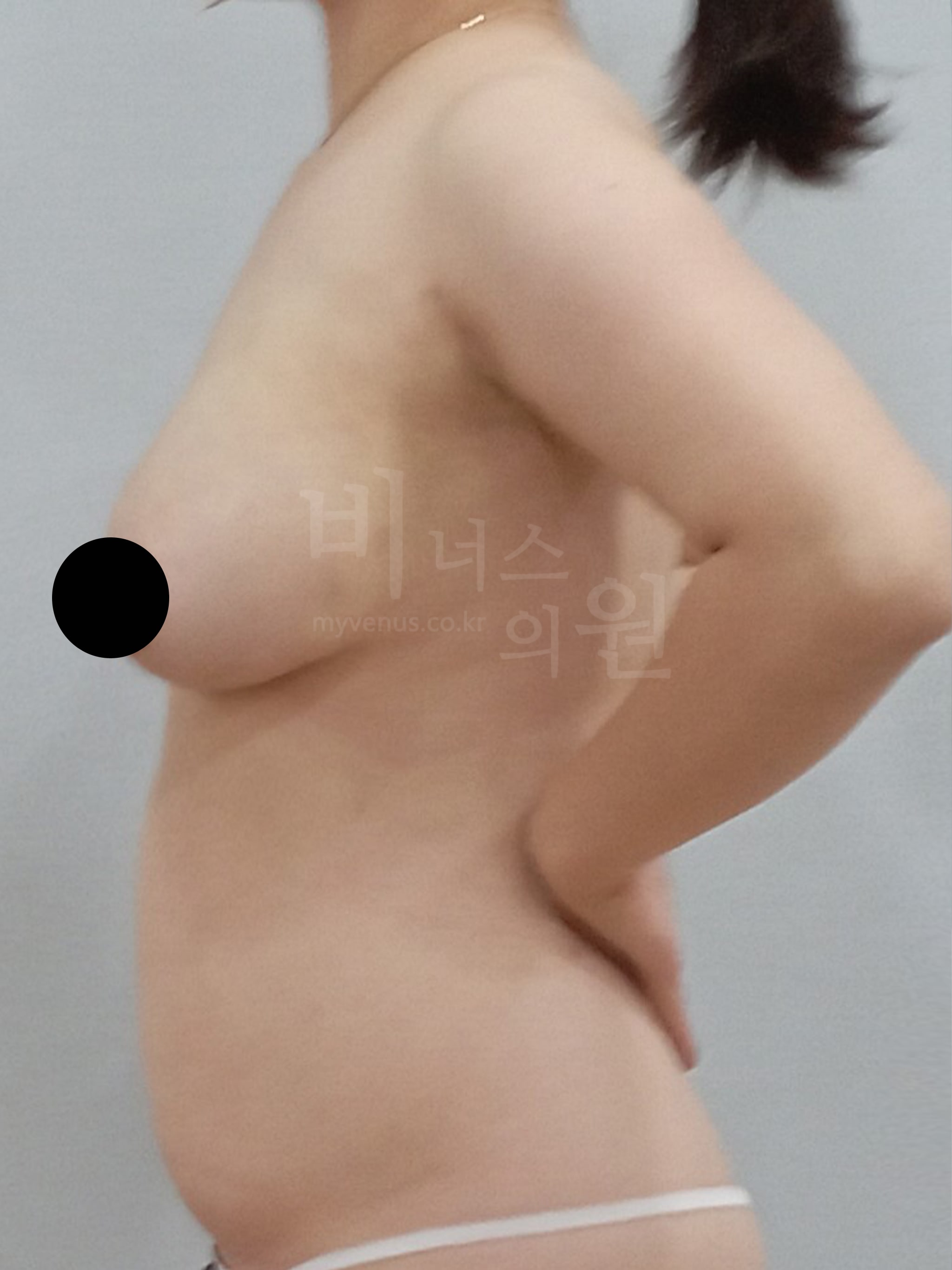 복부지방흡입 전후 사이즈 감소 된 사진.jpg