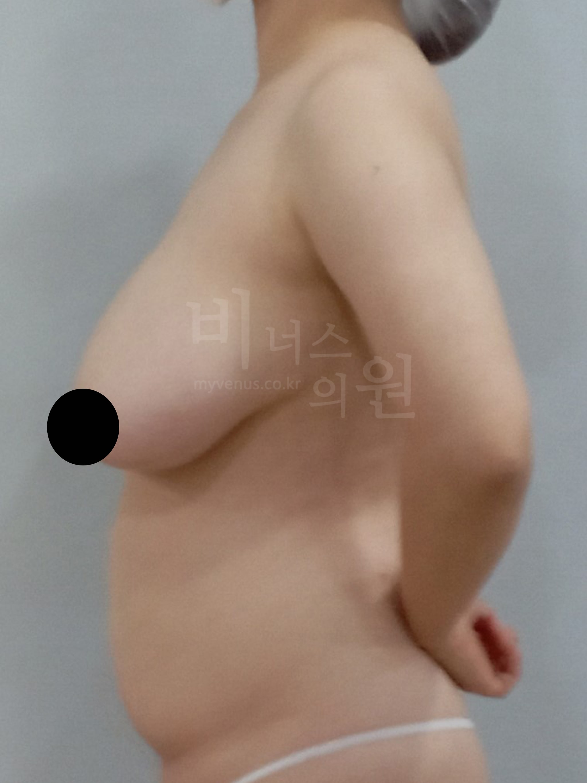 지방흡입 전후 사진.jpg