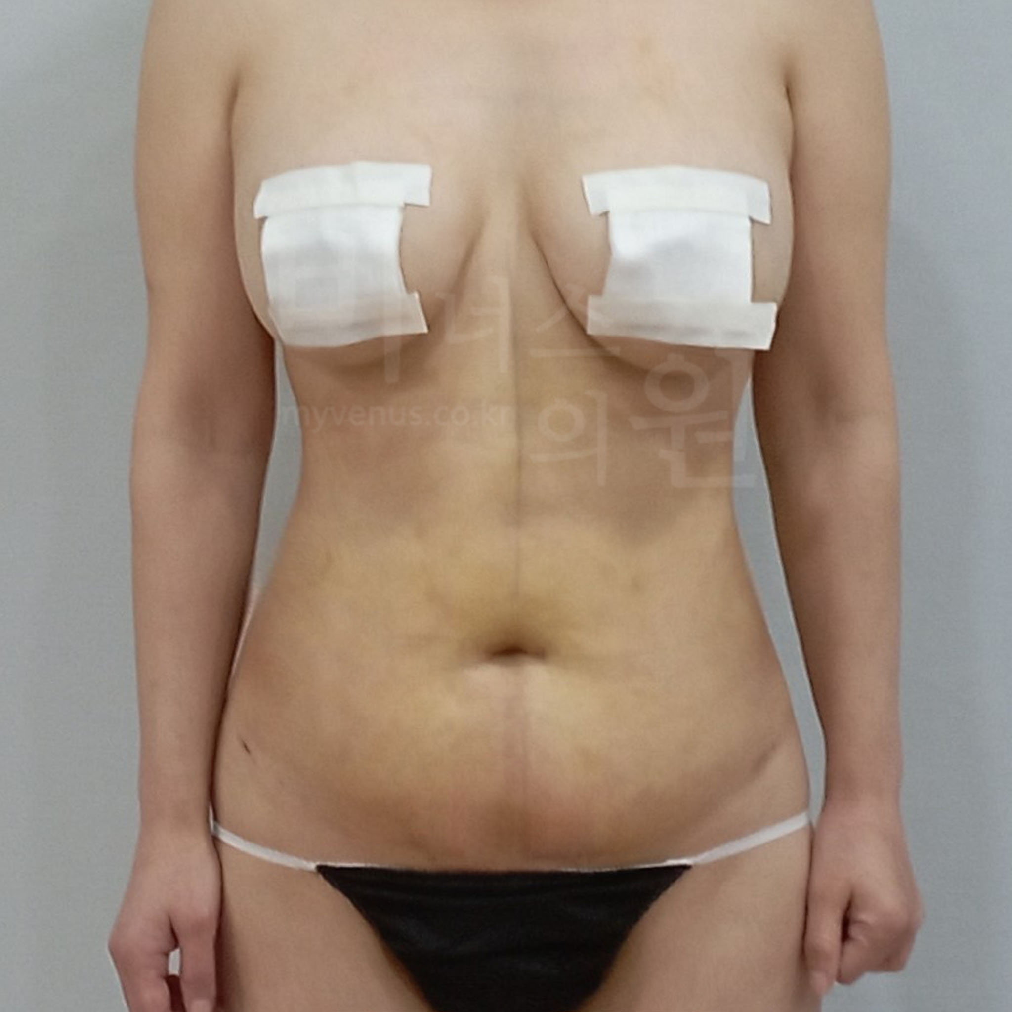 복부지방흡입 압박복.jpg