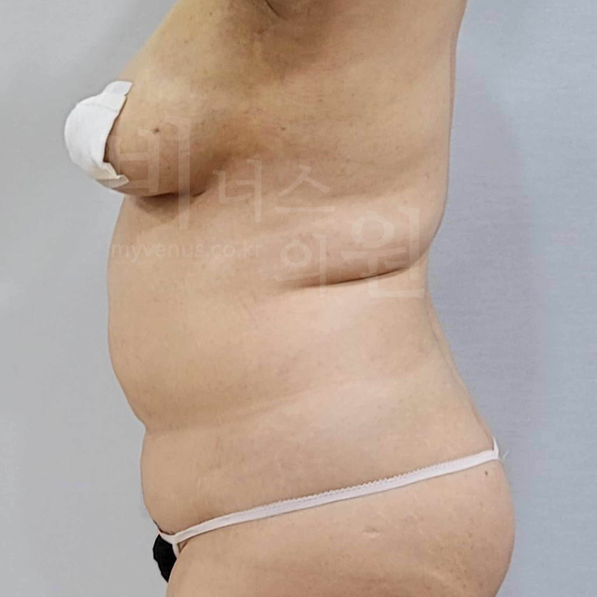 등지방흡입.jpg