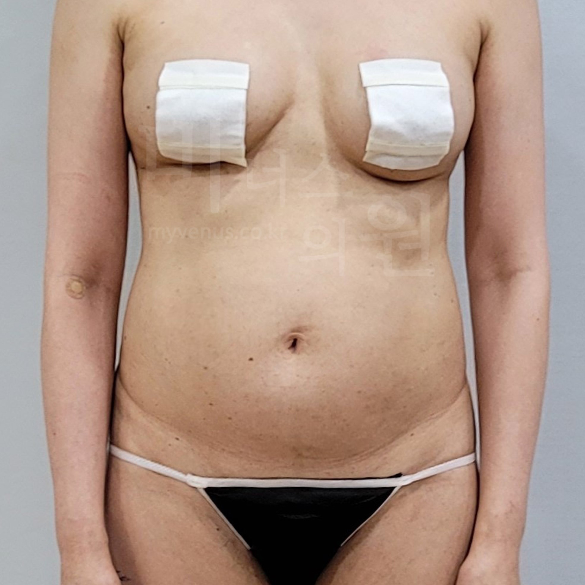 복부비만.jpg
