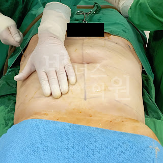 복부지방흡입성공사례.jpg