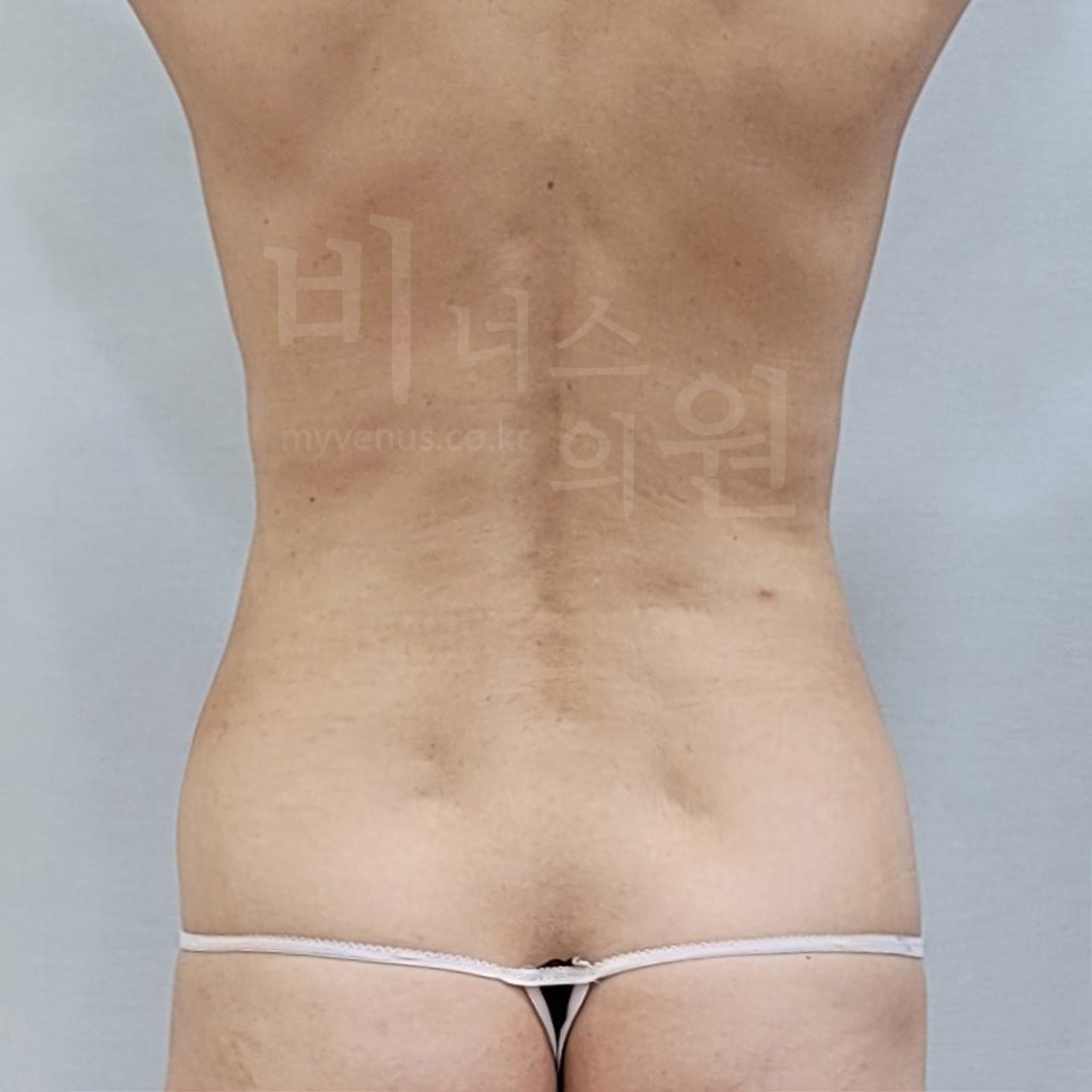 러브핸들지방흡입.jpg