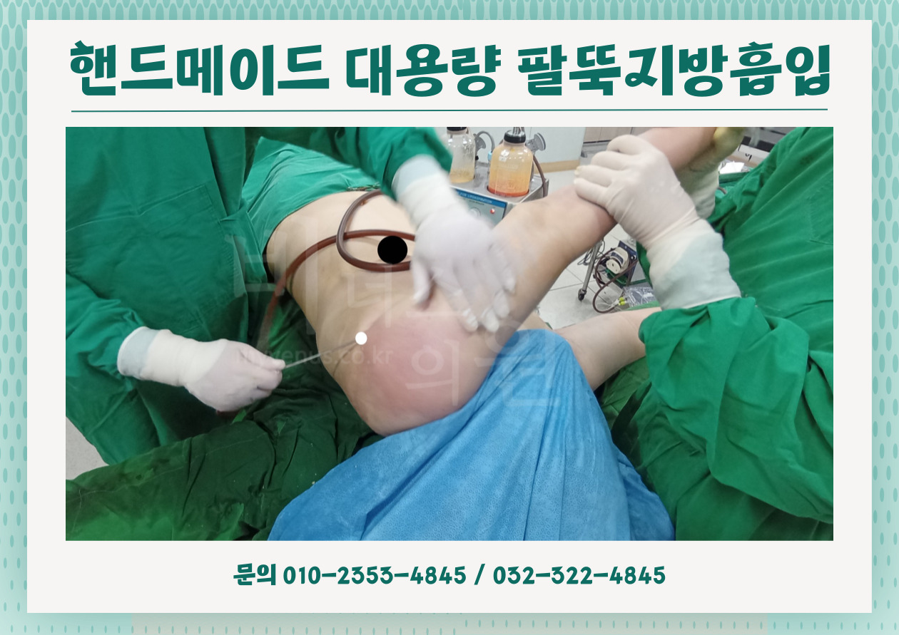 핸드메이드 팔뚝지방흡입