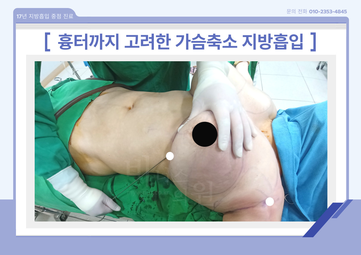 핸드메이드 팔뚝지방흡입