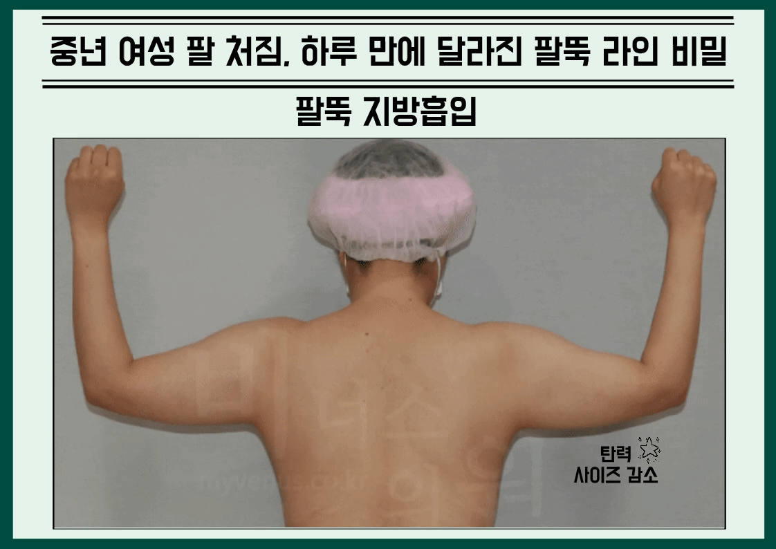 부천지방흡입_2.gif