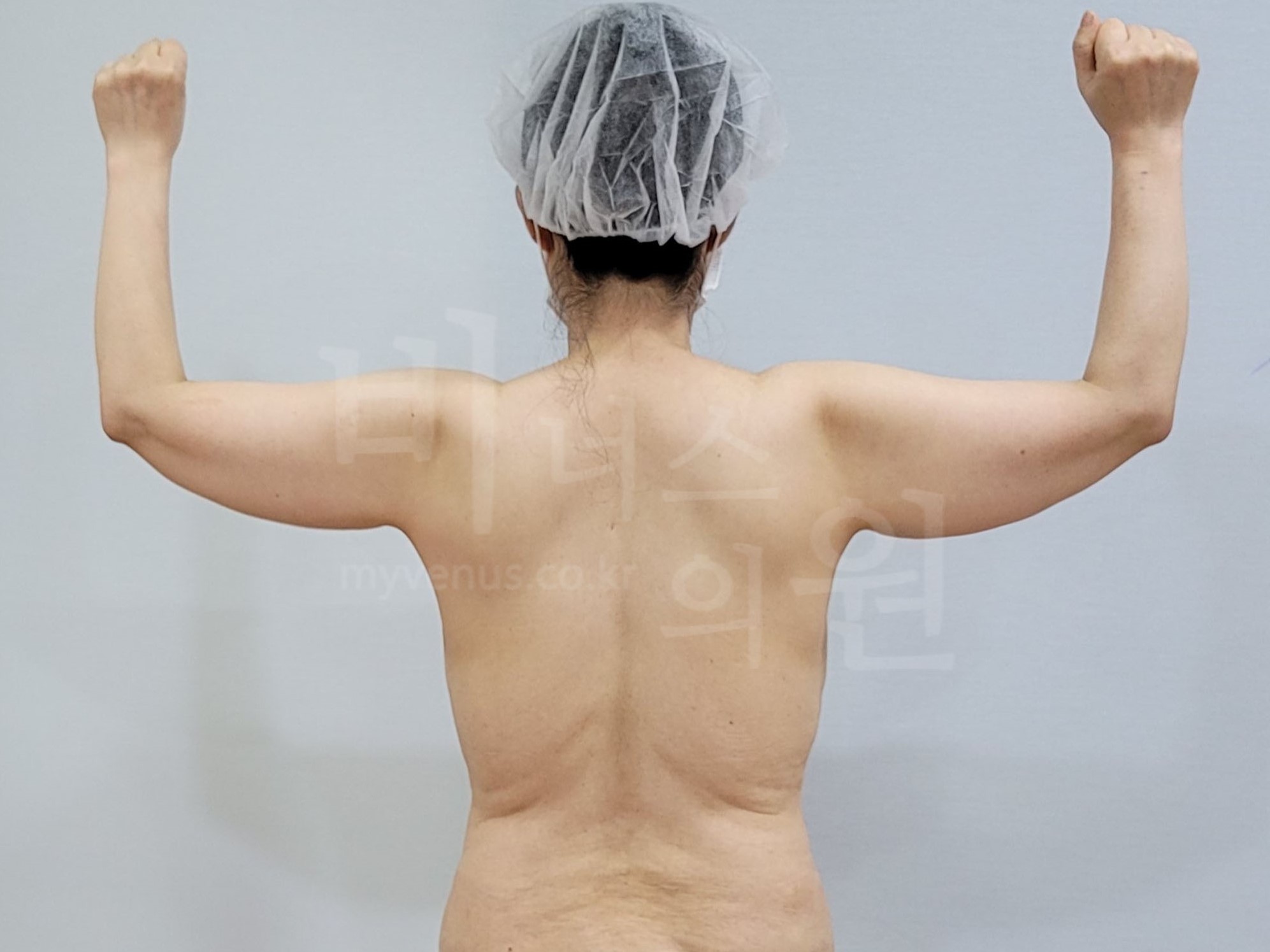 팔뚝지방흡입회.jpg
