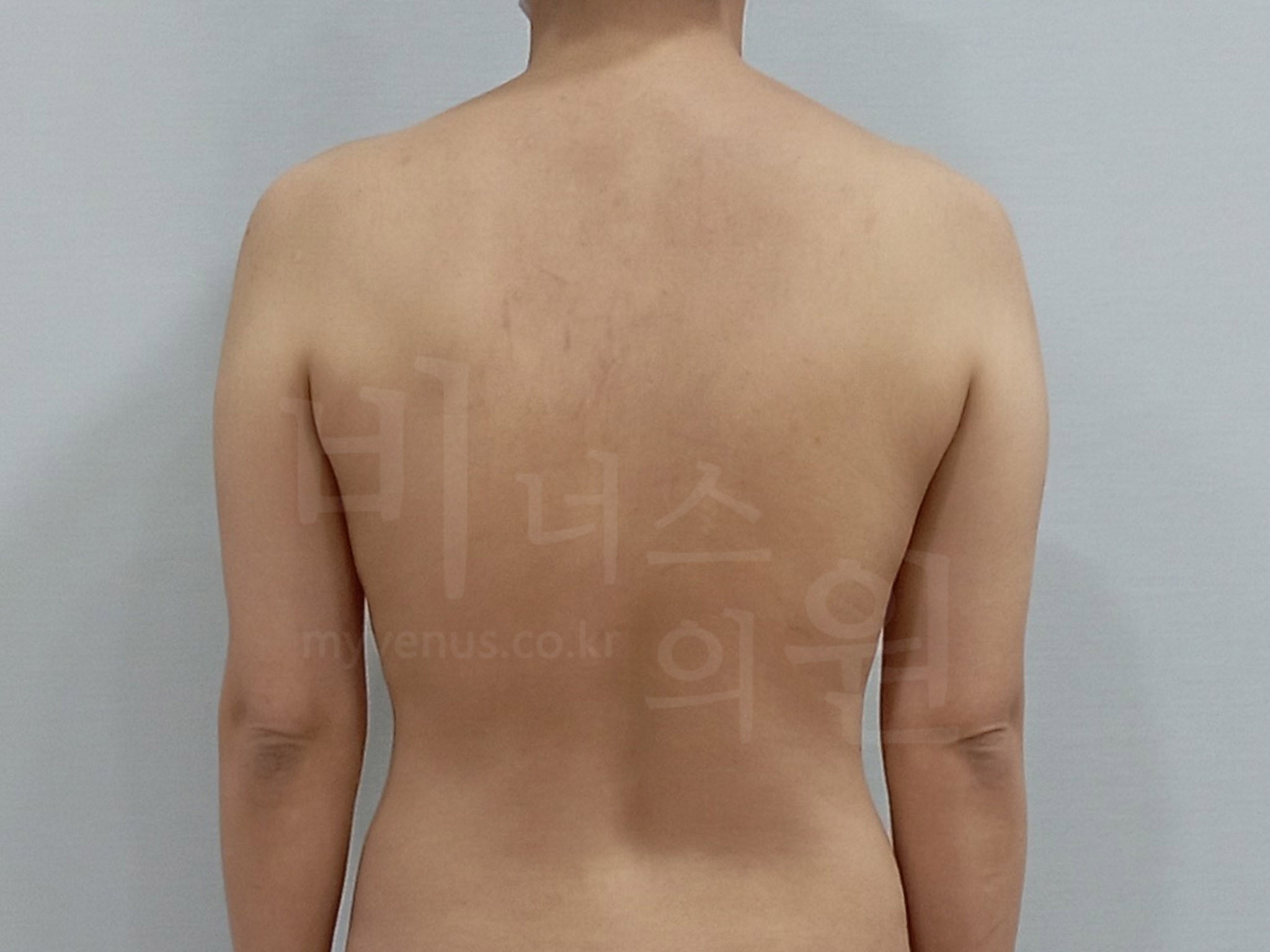 팔뚝살탄력개선.jpg