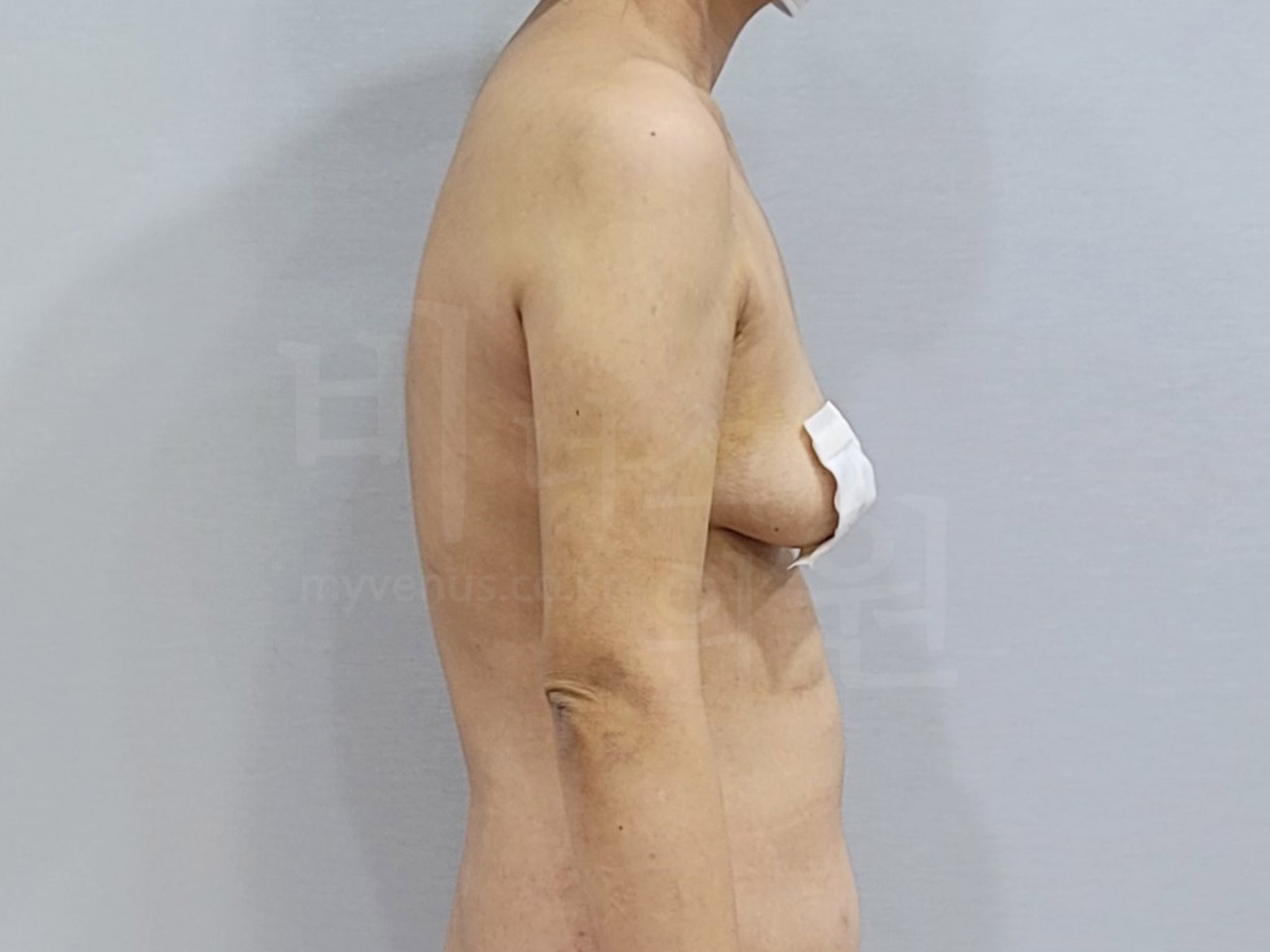 부천지방흡입전문.jpg