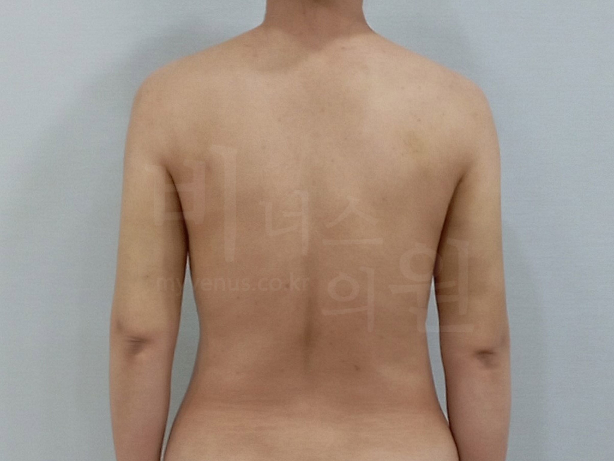 팔뚝지방흡입전후.jpg
