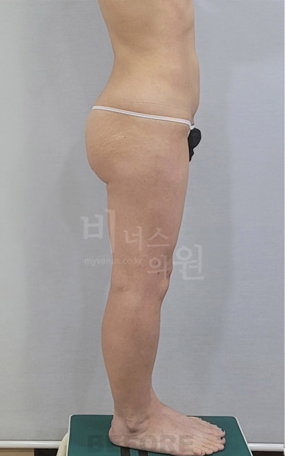 엉덩이 지방흡입 수술 전 반대측 측면