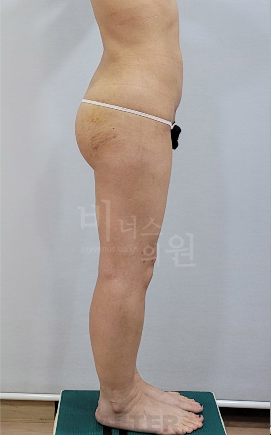 엉덩이 지방흡입 수술 후 반대측 측면