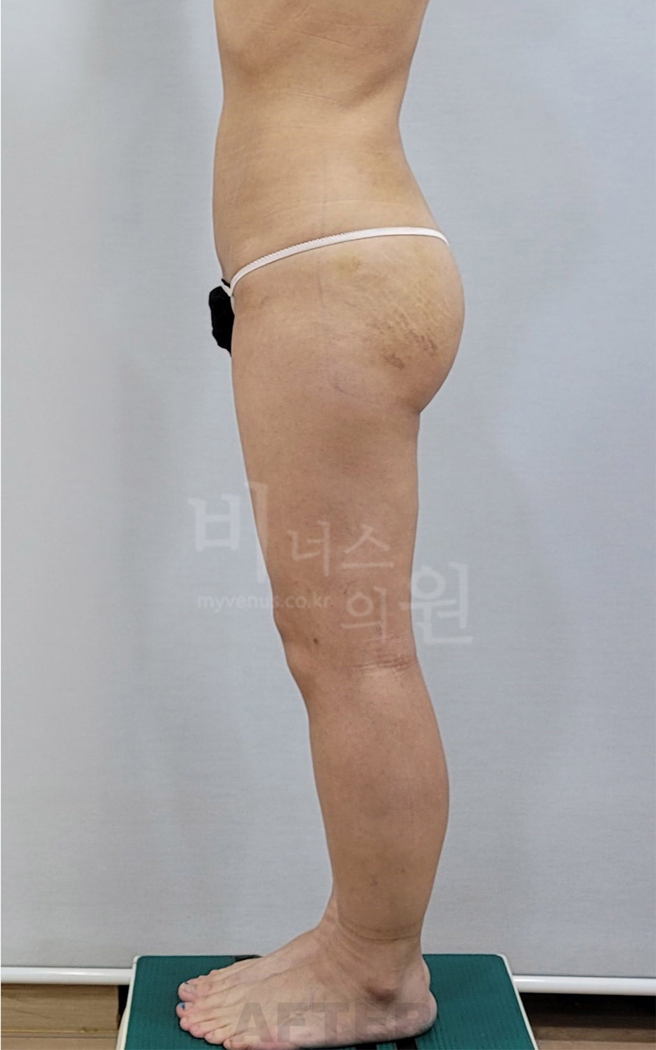엉덩이 지방흡입 수술 후 측면
